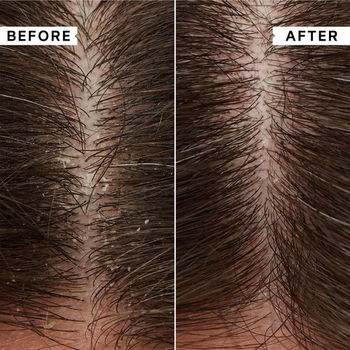 Philip Kingsley Flaky Itchy Scalp Shampoo thumbnail 2