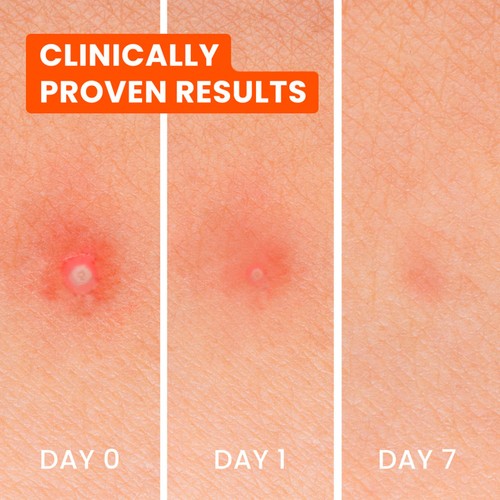 Biore Spot Control 3-in-1 Spot Patches thumbnail 2