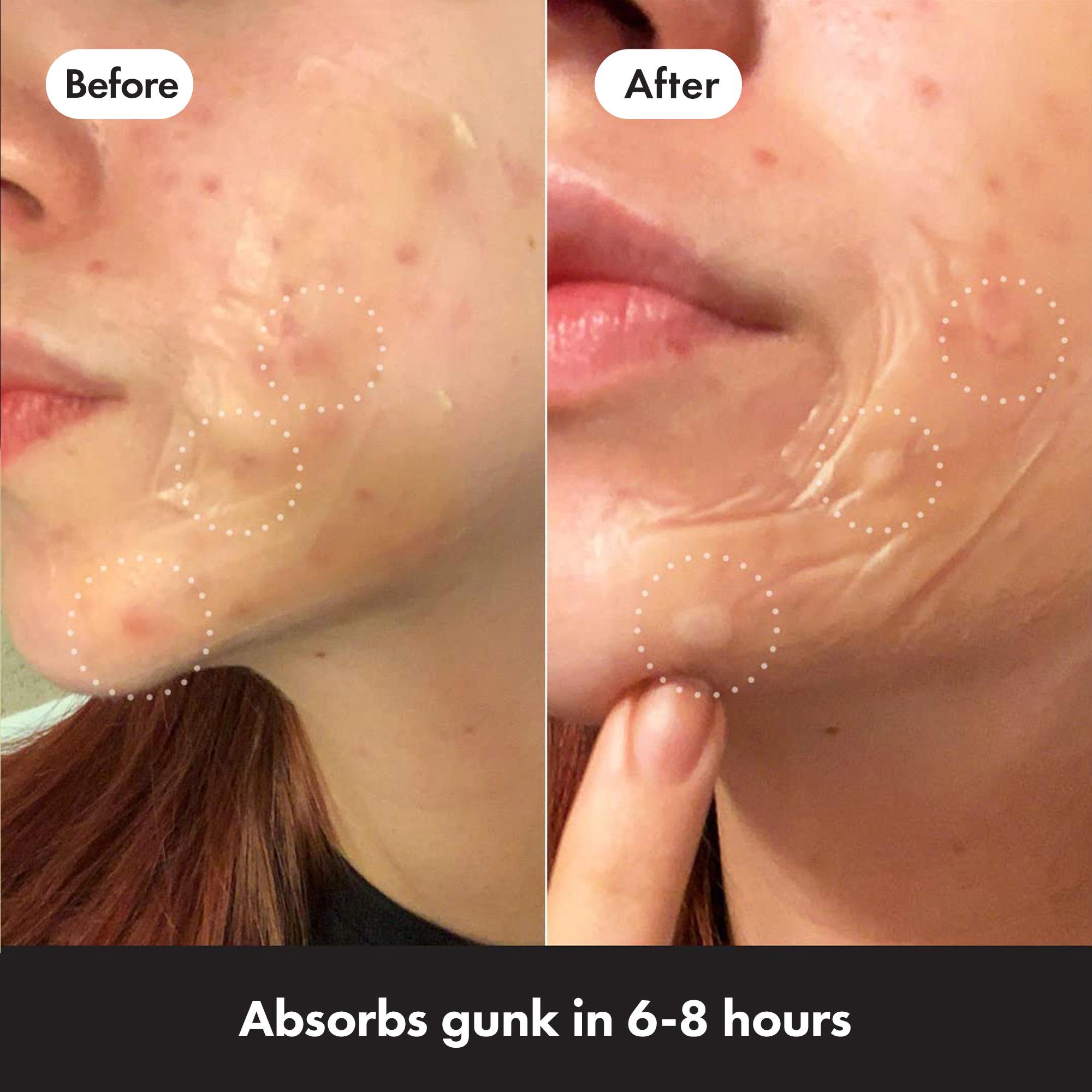 Hero 10 Mighty Surface Spot Pimple Patches thumbnail 4