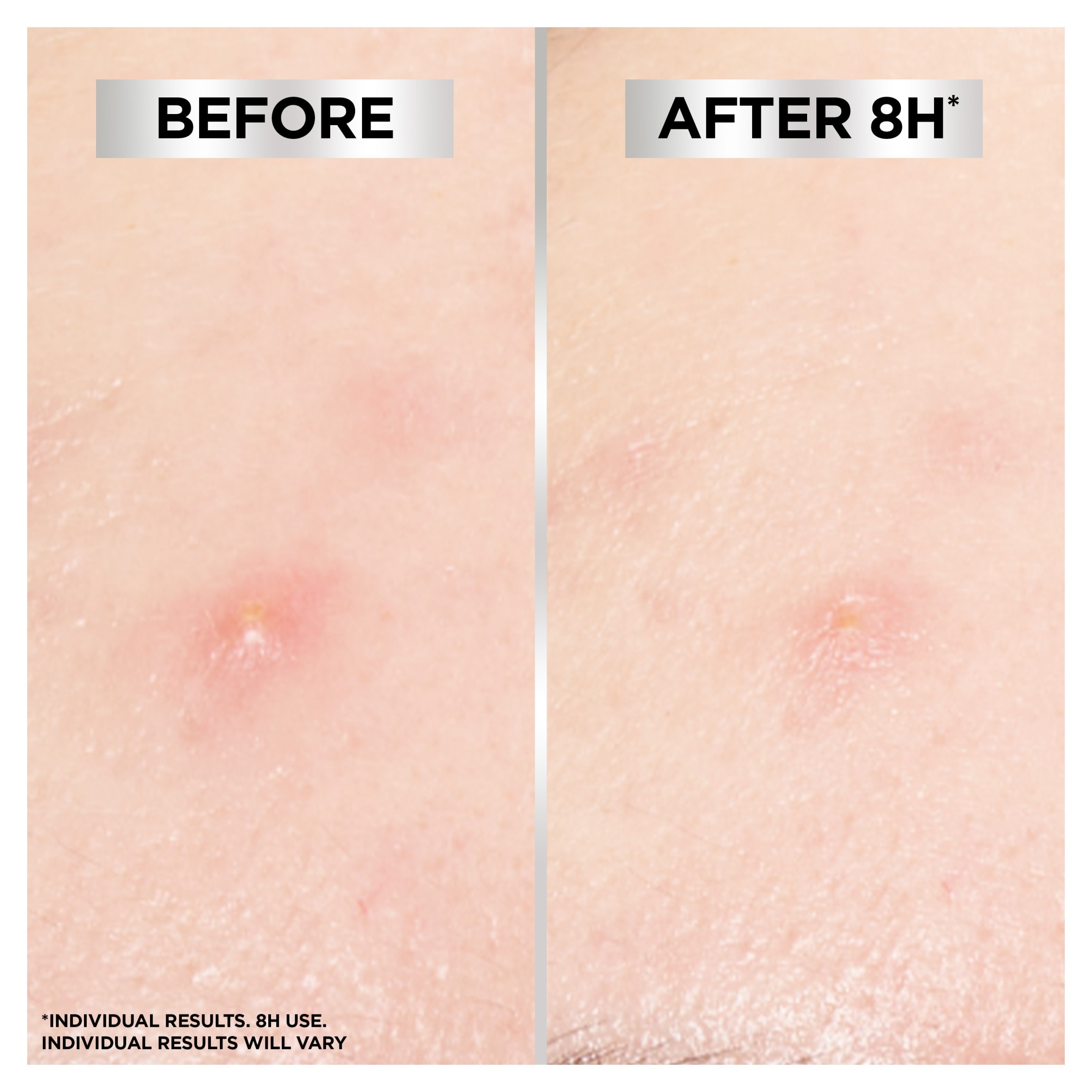Garnier Pure Active Blemish Patch 22 Pack thumbnail 5