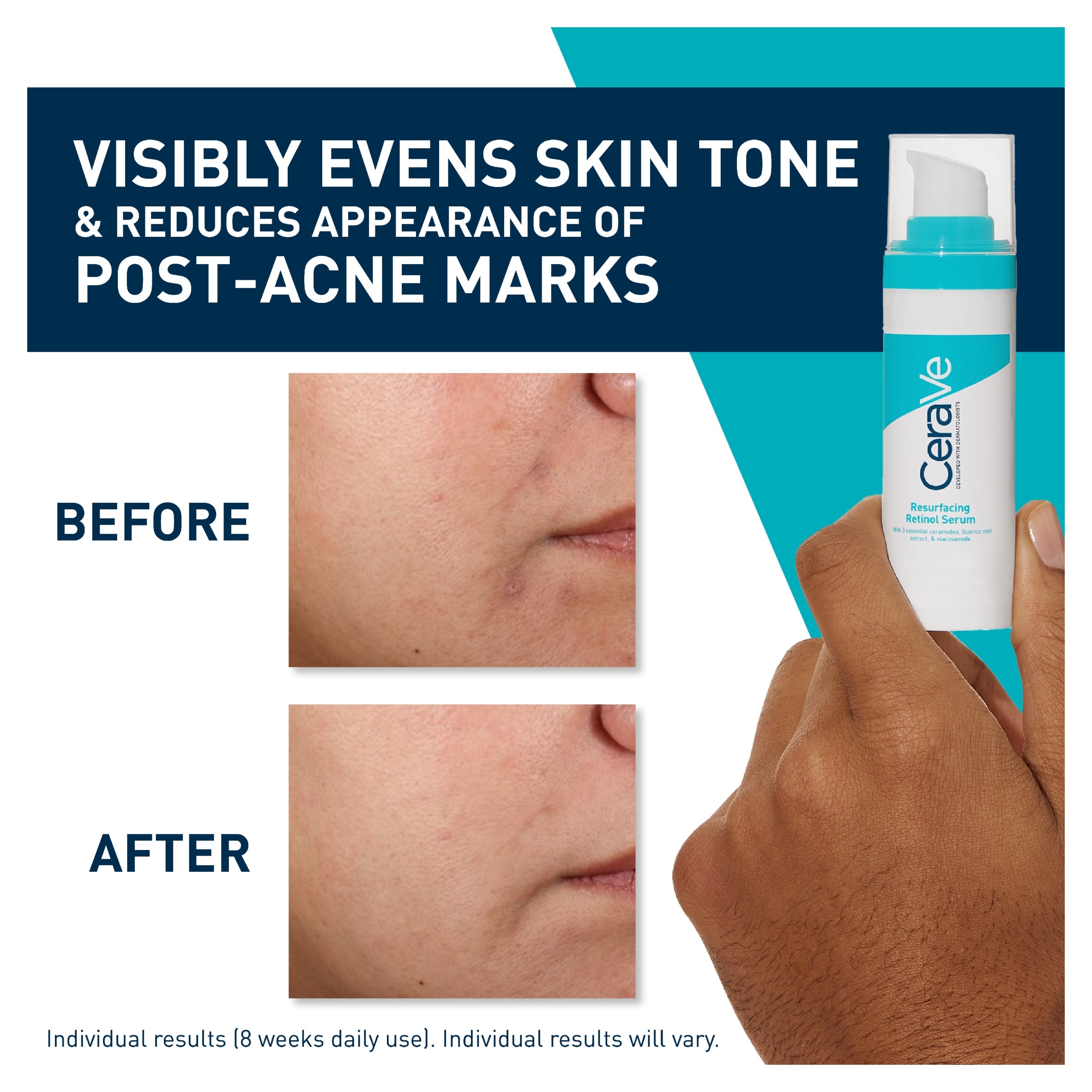 CeraVe Resurfacing Retinol Serum with Ceramides & Niacinamide for Blemish-Prone Skin 30ml thumbnail 5